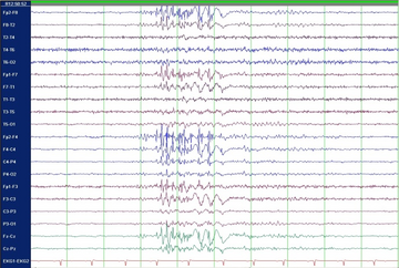 Foto EEG eines Patienten mit genetisch bedingter (idiopathischer) Epilepsie