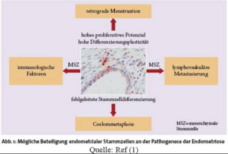 Pathogenese der Endometriose: UKM - Frauenheilkunde und Geburtshilfe