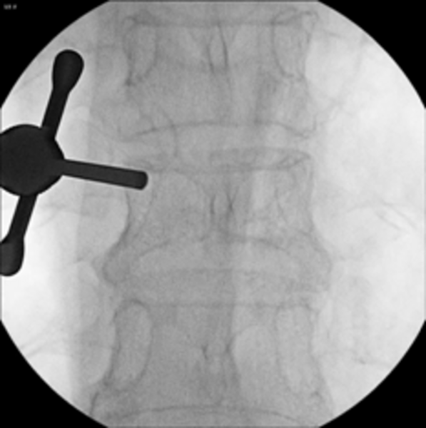 Kyphoplastie UKM Neurochirurgie