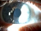 Augenveränderungen bei Fabry-Patient