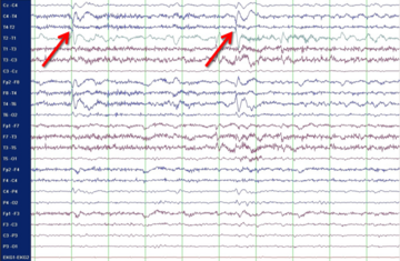 Spitzenpotenziale (Sharp Waves) im EEG 