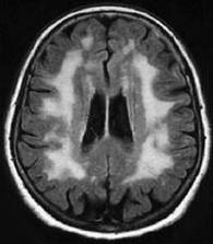 Gehirnläsionen (im MRT-Bild weiß dargestellt) eines Fabry-Patienten, ausgelößt durch eine Beteiligung der kleinen Gehirngefäße