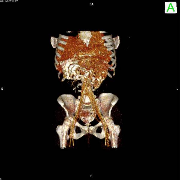 Volume Rendering: UKM - Nuklearmedizin