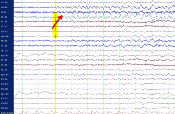 Illustration Anfallsmuster im EEG