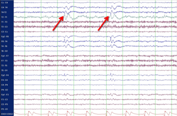 Spitzenpotenziale (Sharp Waves) im EEG 