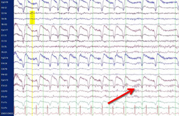 Illustration Anfallsmuster im EEG