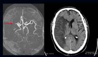 Schlaganfall bei einem Fabry-Patienten durch den Verschluß eines großen Gehirngefäßes (Pfeil)